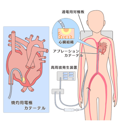 >アブレーション