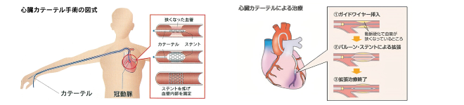 >心臓血管カテーテル治療(PCI)
